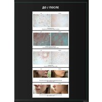 LifeCode Anti acne 30 мл