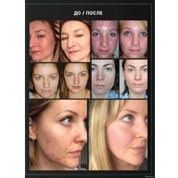 LifeCode Anti acne 30 мл